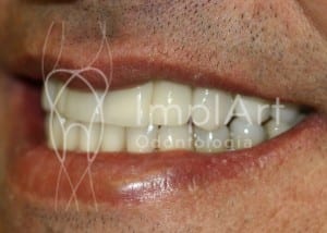 implante_dentario_total_zirconia reclame