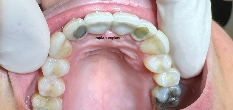 protese fixa metalocaremica de 4 dentes anterior b