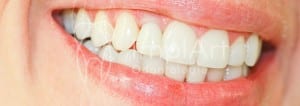 carga imediata implante dentario 2 dente