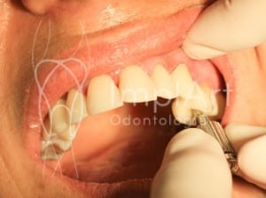 carga imediata_implantes dentario