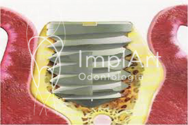 Reabilitação oral com próteses projetadas em computador – Implante dentário e estética dental