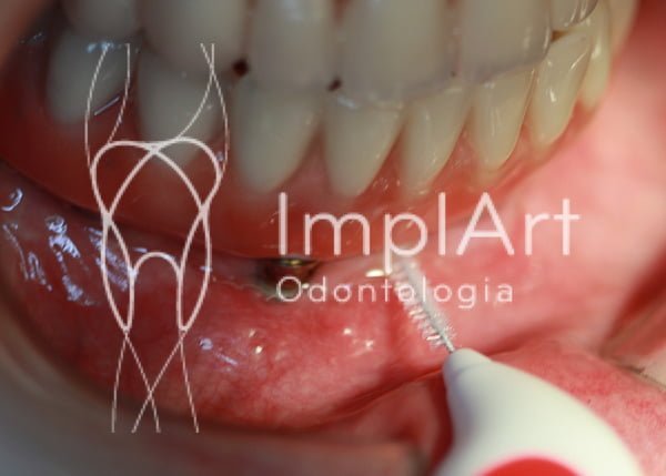 limpeza do implante dentario 7403677144 l
