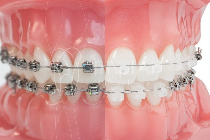 Aparelhoortodonticoautoligadodamon50kb Clínica Odontológica De Implante Dentário 