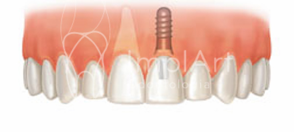 Planejamento de implante dentário e osseointegração