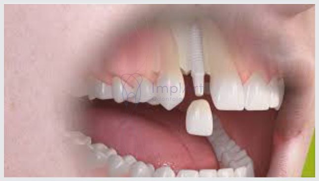Os desafios dos implantes dentários em área estética