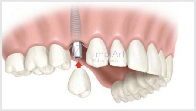 Implante dentário com carga imediata: indicações e contra indicações