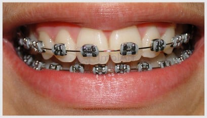 Tratamento mal feito com aparelho ortodôntico pode levar a perda dos dentes