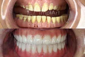 troca dentadura por protese fixa implantes zirconia metaloplastica 50kb