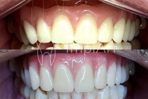troca protese dentaria metaloplastica 50kb