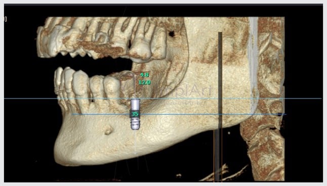 ImplArt agora oferece Tomografia Computadorizada 3D