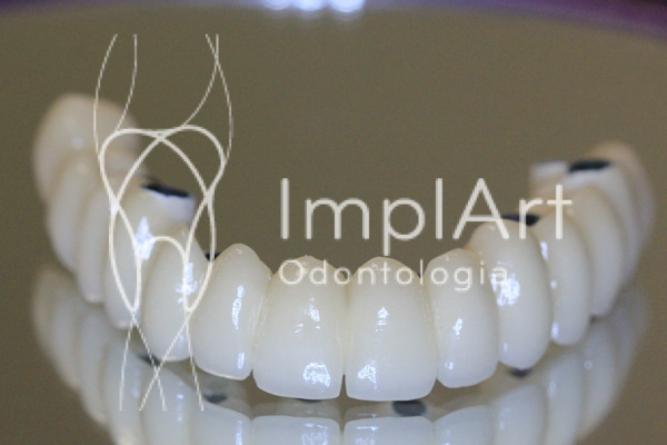 Implante total sem gengiva: prótese completa com dentes individuais