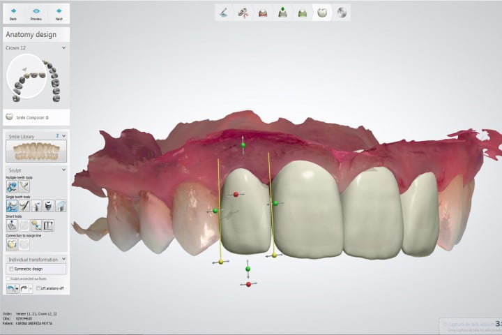 projetando coroas dentes da frente 50kb