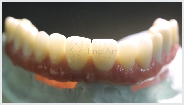 Implante dentário para a boca toda é um tratamento fácil e gratificante