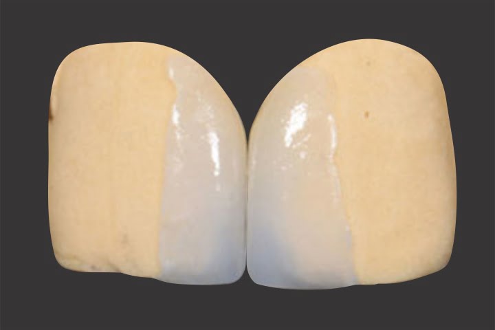 fragmento ceramico diastema 49kb