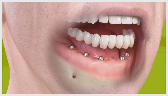 Limpeza e manutenção de implantes dentários e próteses