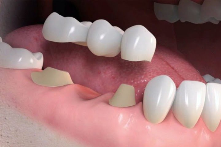 prótese fixa sobre dentes