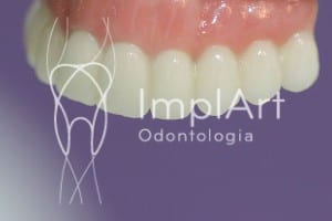 implante total gengiva e dentes ceramicos