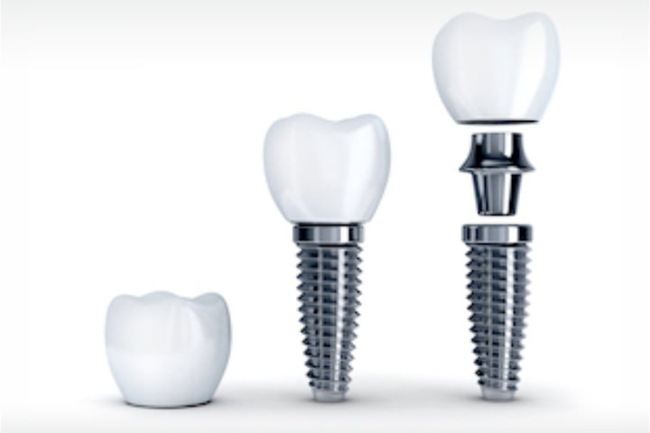 Implante dentário valor: 