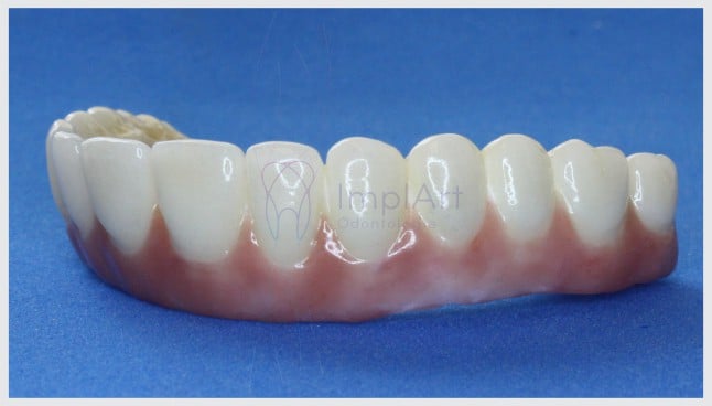 Prótese dentária fixa de porcelana sobre dentes com ou sem gengiva
