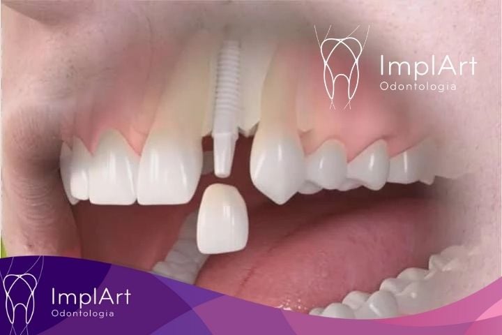 Implantes dentários: alimentação e cuidados após a cirurgia 2 implante após a cirurgia