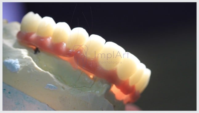 Implantes de todos os dentes