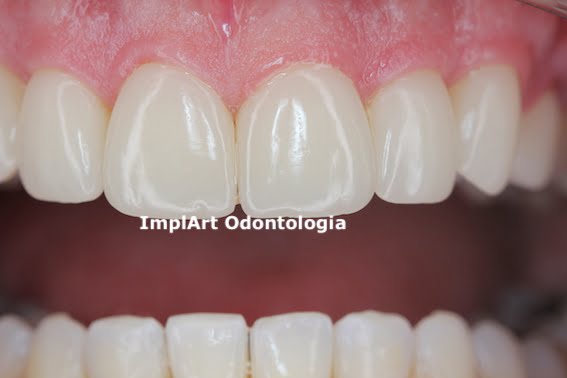 osseointegração_implante_dentario