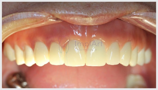 Implante total dos dentes superiores