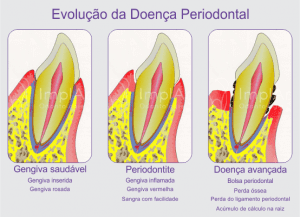 Bolsa periodontal