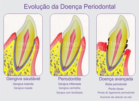 Bolsa periodontal 3