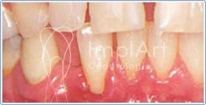 bolsa periodontal