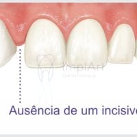 Agenesia: dentes que não nasceram podem ser supridos com implantes?