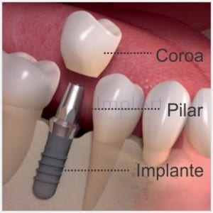 implante pilar coroa