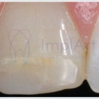 Restaurações de resina podem se arranhar com pasta de dente