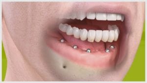 implante_todos_os_dentes