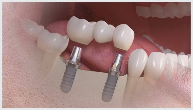 Quantos implantes dentários são colocados de cada vez?