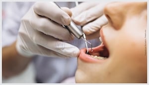 Anestesia eletrônica no Dentista