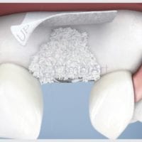 Ficarei sem prótese dentária durante o enxerto ósseo?