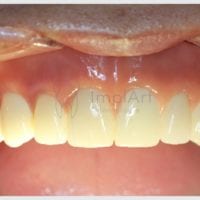 Implantes dentários: a sensação de voltar a sorrir