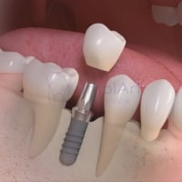 Fico sem o dente durante o implante dentário?