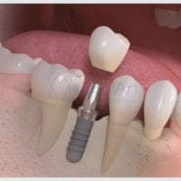 Pessoas com periodontite podem colocar implante?