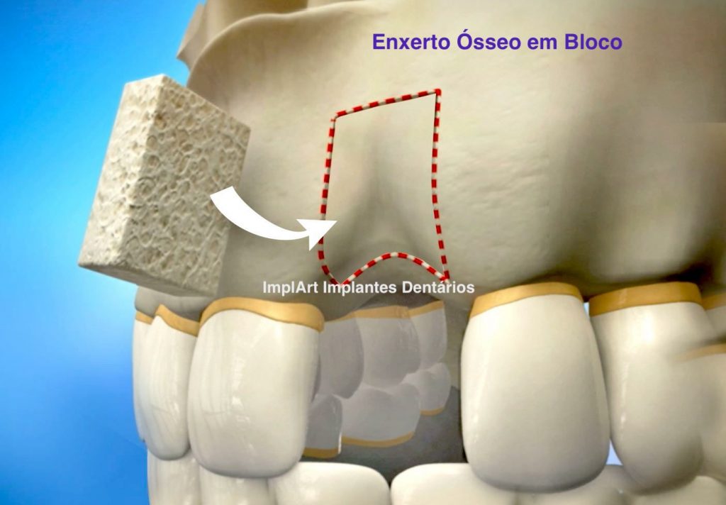 enxerto osseo em bloco, enxerto ósseo dentário em bloco