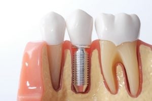 clinica de implante dentario