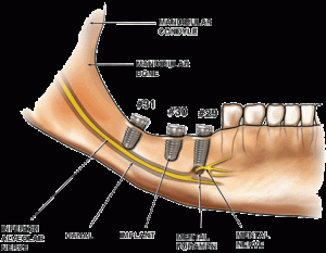 mandibula implantes nervo