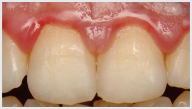 Tratamento para bolsa periodontal