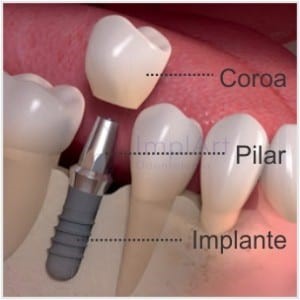 coroa pilar implante