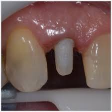 Não confunda implante dental com coroas.