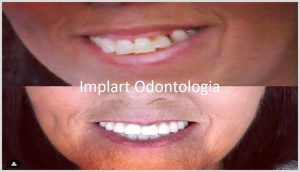 Reabilitacao oral com implantes dentarios 40kb 1