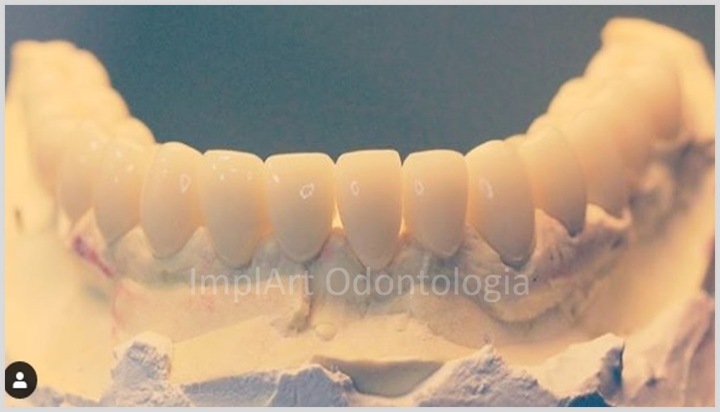 Implante dentário | Prótese com todos os dentes individualizados