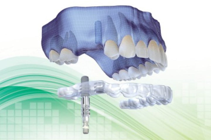 Cirurgia de implante guiada (fechada) ou cirurgia aberta