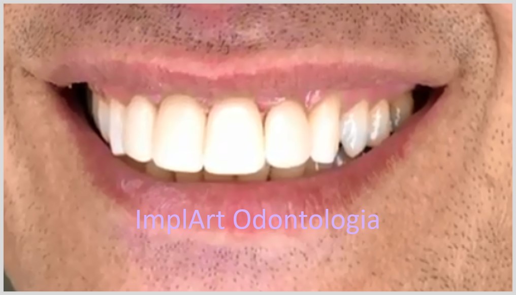 Estética dental com prótese dentária e coroas em porcelana – metal free